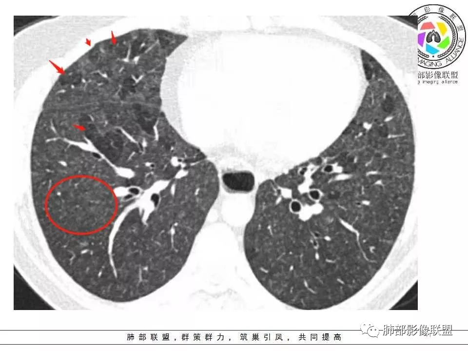 影像PPT - 【病例】肺孢子菌肺炎1例CT影像讨论-14 影像PPT - 【病例】肺孢子菌肺炎1例CT影像讨论-14