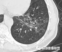 影像PPT - 【病例】肺孢子菌肺炎1例CT影像讨论-17 影像PPT - 【病例】肺孢子菌肺炎1例CT影像讨论-17