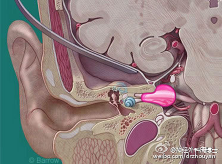 影像PPT - 听神经瘤影像要点及鉴别诊断-21