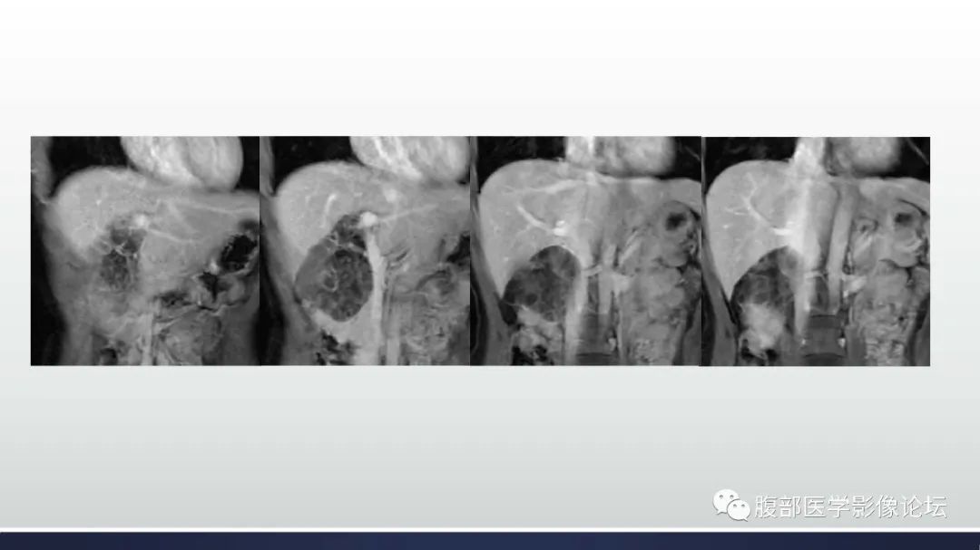 影像PPT - 【病例】胆管囊腺瘤1例CT及MR影像-15