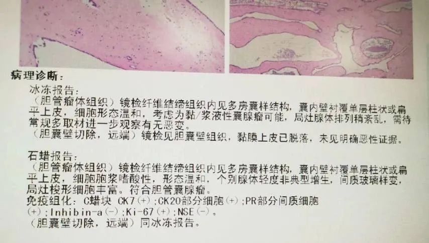 影像PPT - 【病例】胆管囊腺瘤1例CT及MR影像-16