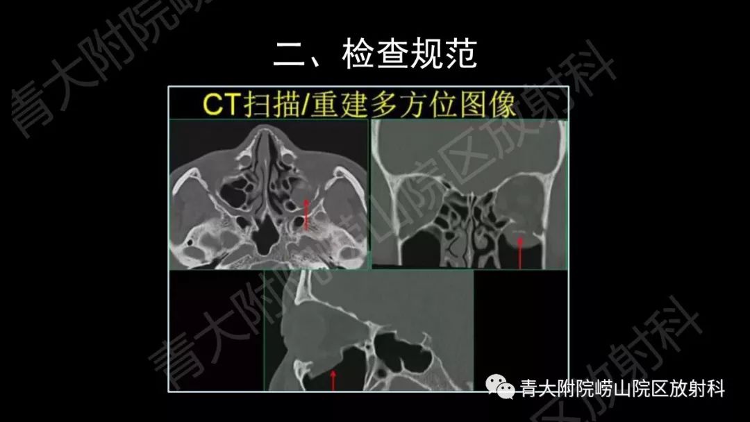 影像PPT - 【PPT】头颈部影像检查报告规范-15