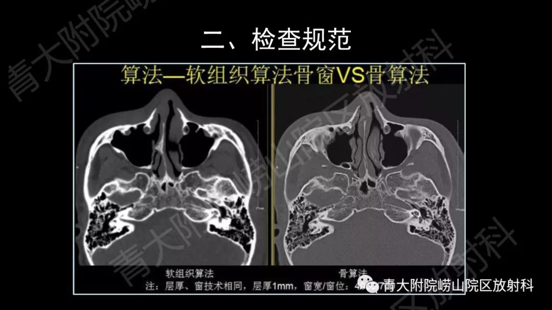 影像PPT - 【PPT】头颈部影像检查报告规范-16