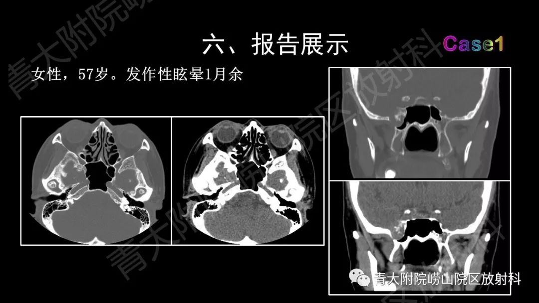 影像PPT - 【PPT】头颈部影像检查报告规范-51