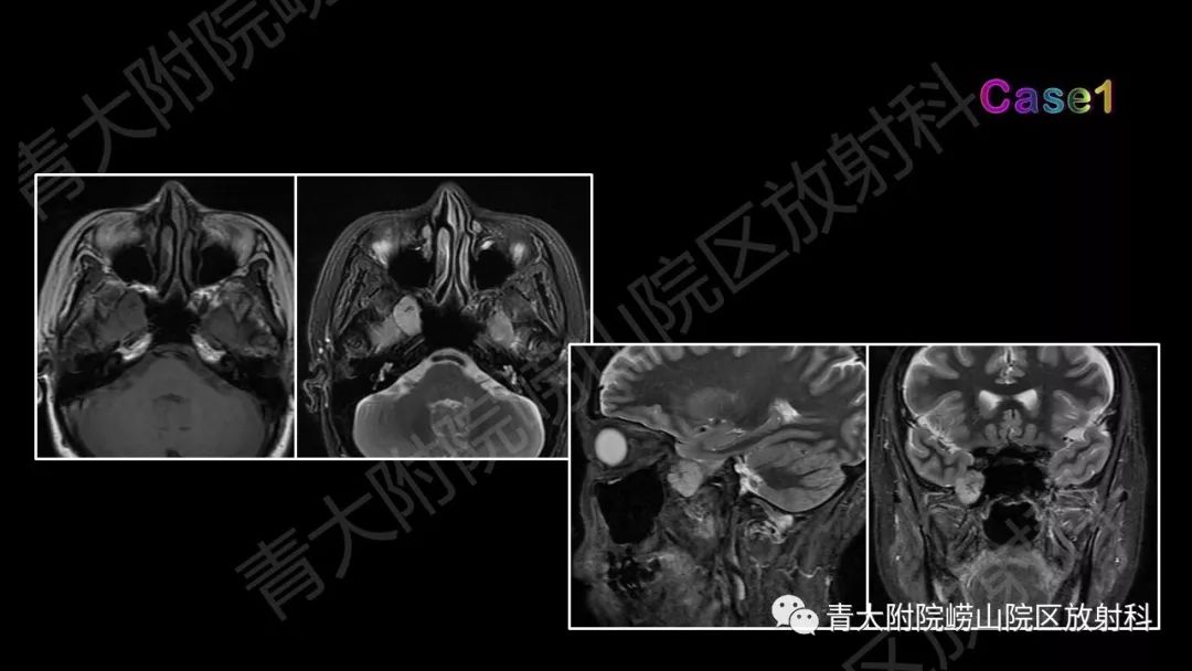影像PPT - 【PPT】头颈部影像检查报告规范-52