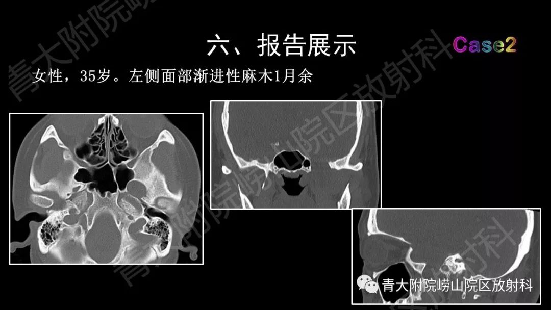 影像PPT - 【PPT】头颈部影像检查报告规范-56