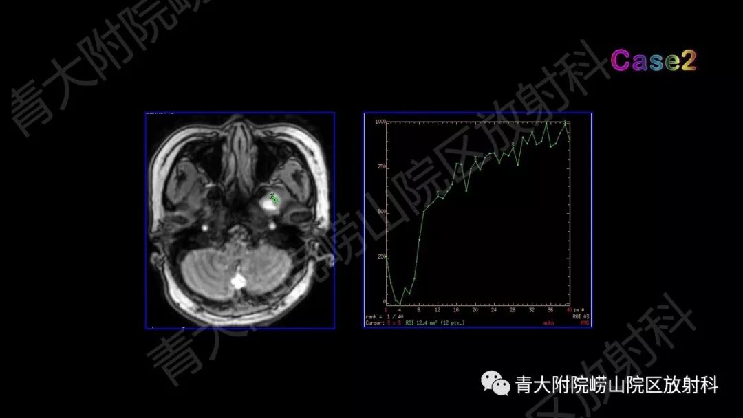 影像PPT - 【PPT】头颈部影像检查报告规范-59