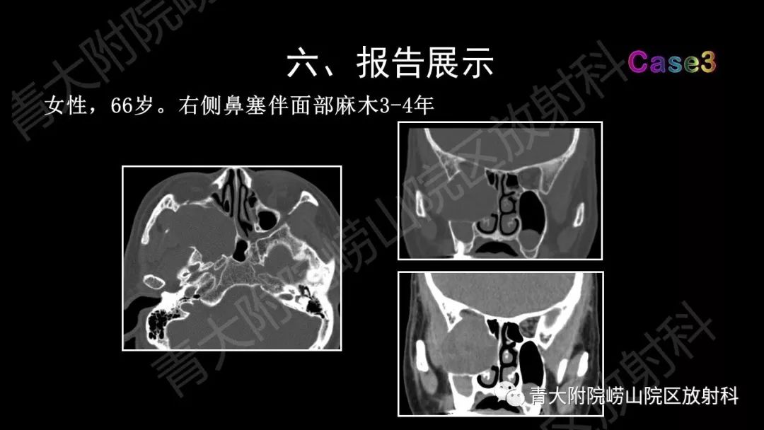 影像PPT - 【PPT】头颈部影像检查报告规范-61