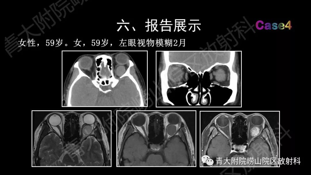 影像PPT - 【PPT】头颈部影像检查报告规范-65
