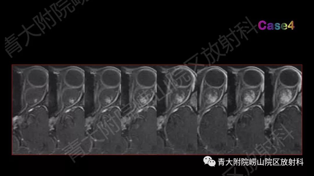 影像PPT - 【PPT】头颈部影像检查报告规范-66