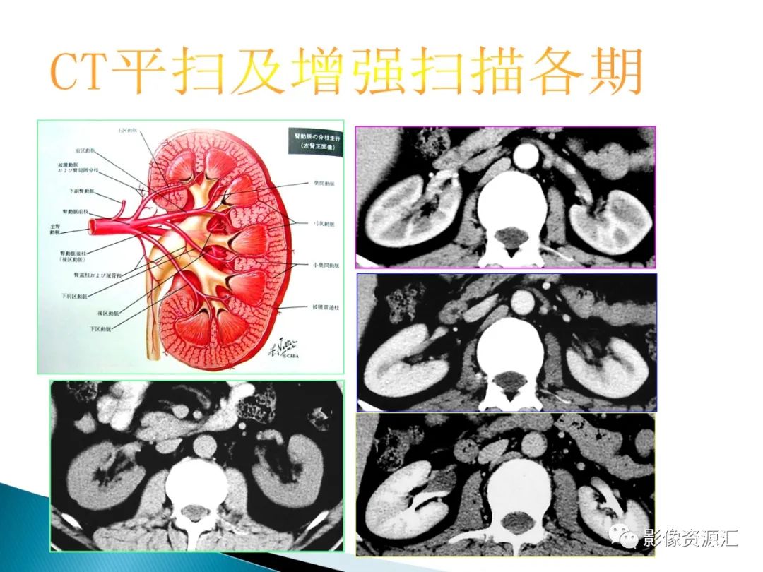 影像PPT - 【PPT】肾癌的CT MRI诊断-5