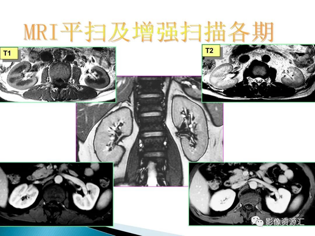 影像PPT - 【PPT】肾癌的CT MRI诊断-7