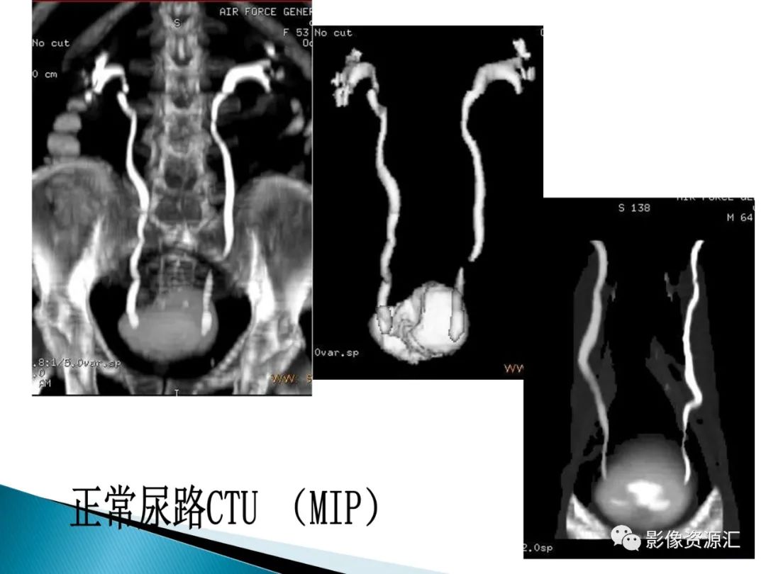 影像PPT - 【PPT】肾癌的CT MRI诊断-9