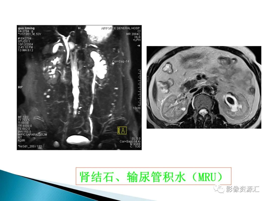 影像PPT - 【PPT】肾癌的CT MRI诊断-11