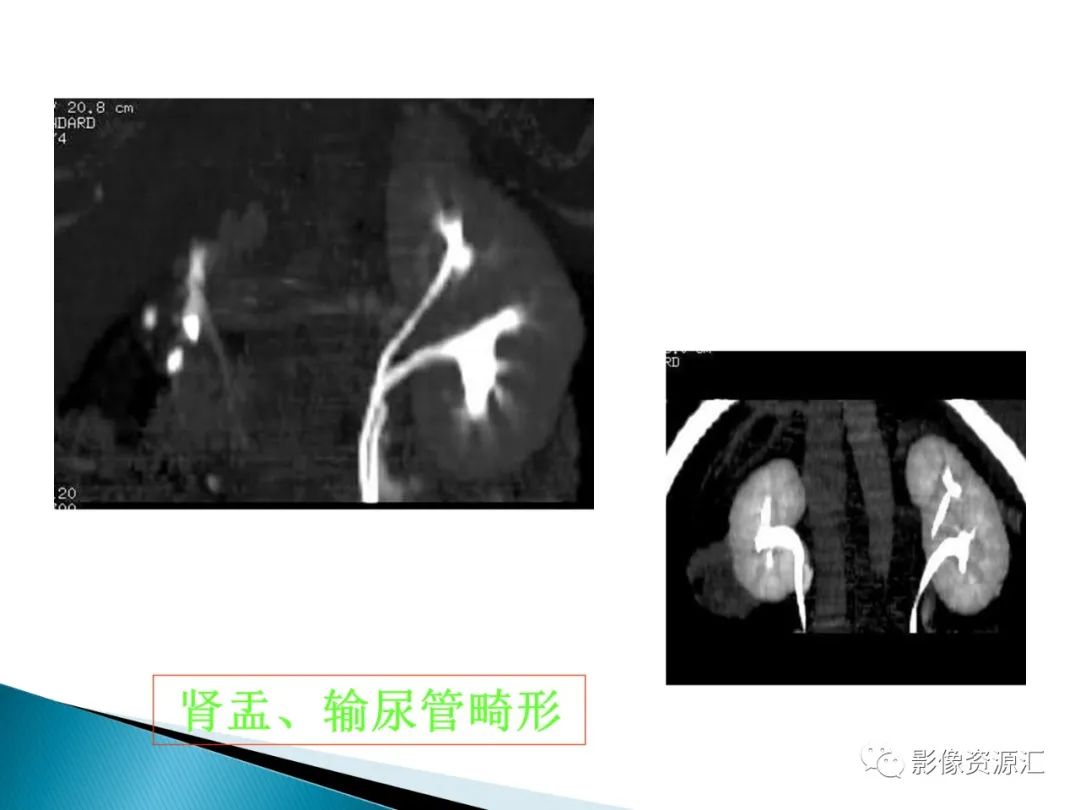 影像PPT - 【PPT】肾癌的CT MRI诊断-12