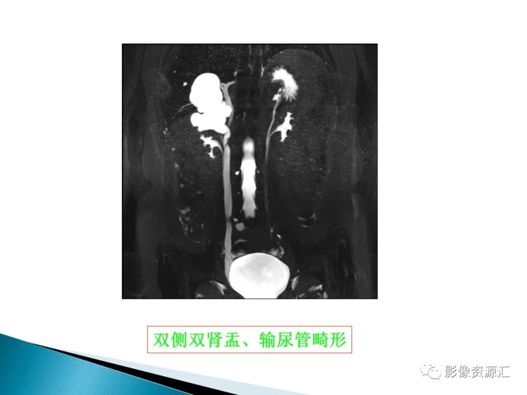 影像PPT - 【PPT】肾癌的CT MRI诊断-13