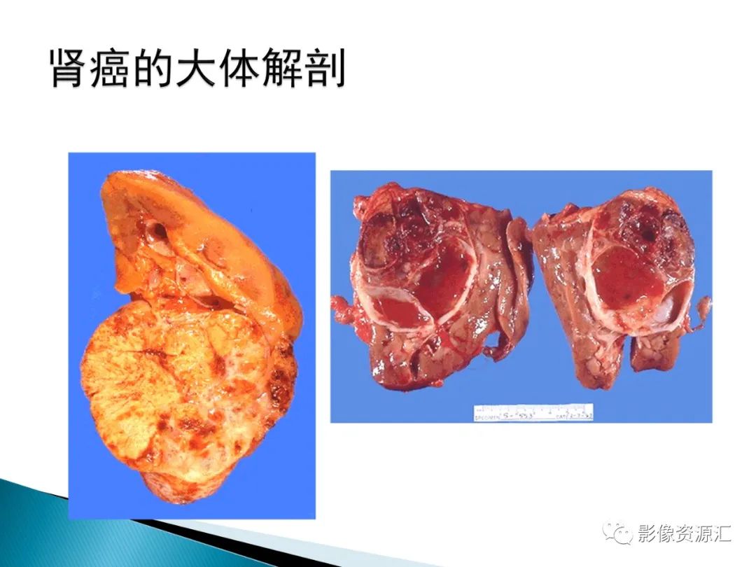 影像PPT - 【PPT】肾癌的CT MRI诊断-16