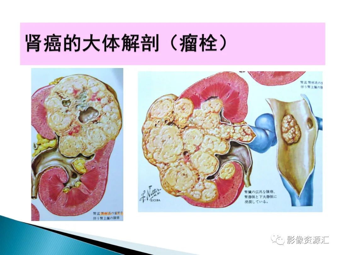 影像PPT - 【PPT】肾癌的CT MRI诊断-17