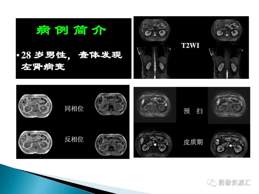影像PPT - 【PPT】肾癌的CT MRI诊断-23