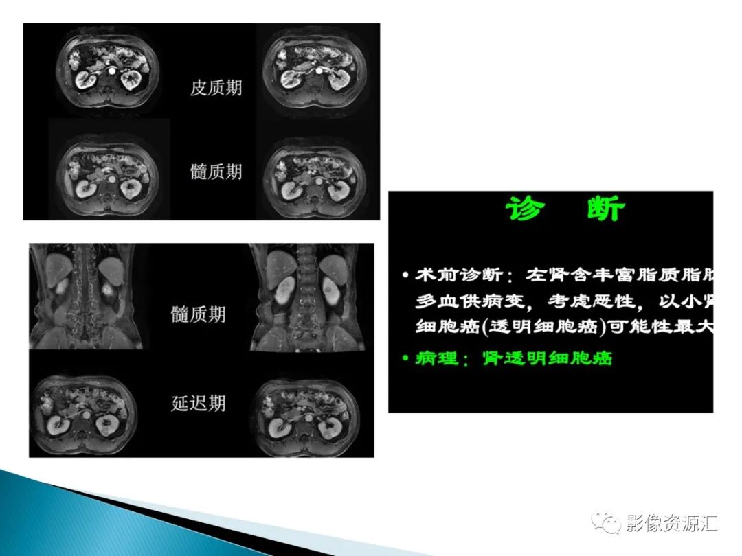 影像PPT - 【PPT】肾癌的CT MRI诊断-24