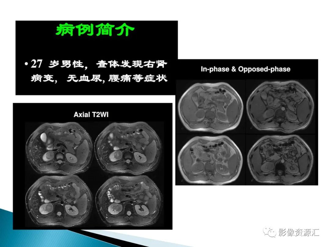 影像PPT - 【PPT】肾癌的CT MRI诊断-25