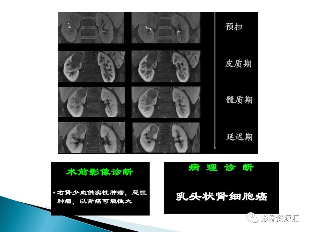 影像PPT - 【PPT】肾癌的CT MRI诊断-26