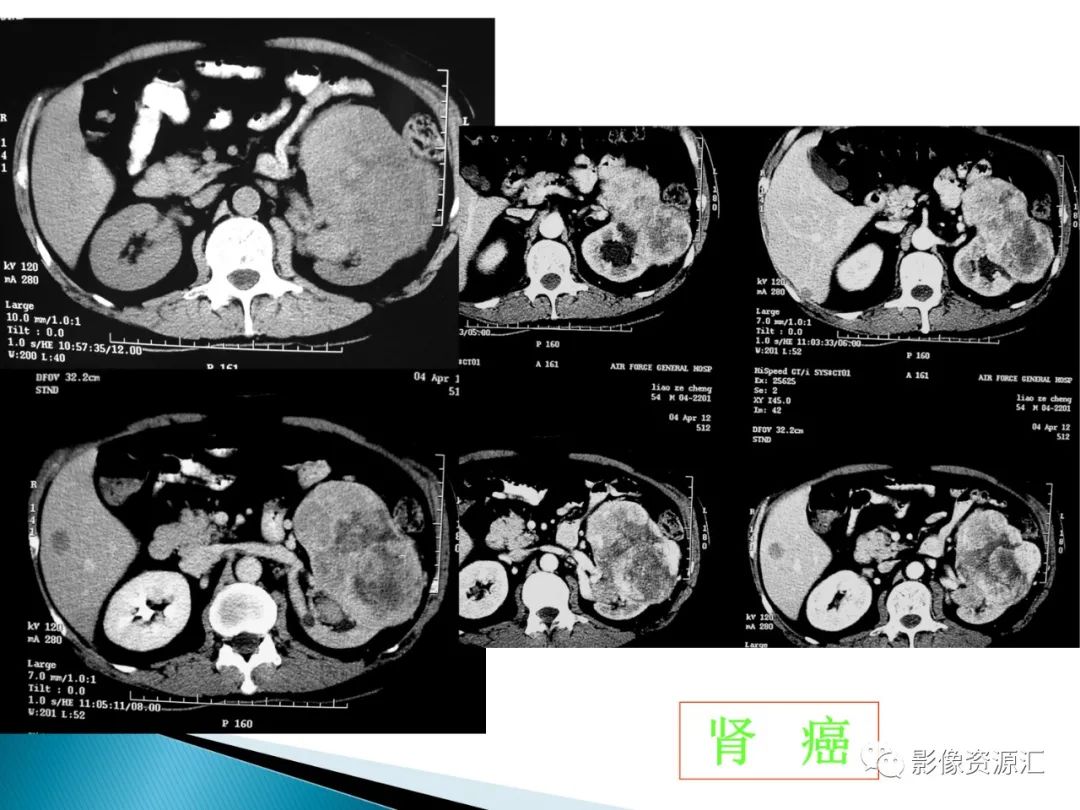 影像PPT - 【PPT】肾癌的CT MRI诊断-27