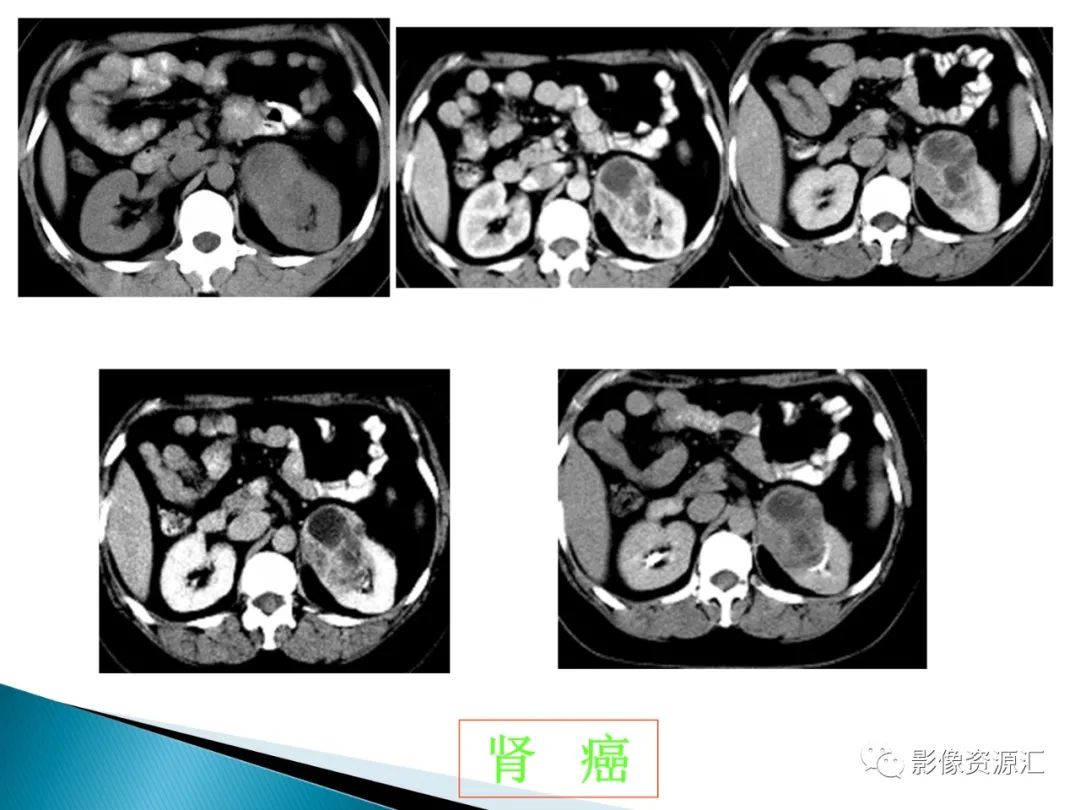 影像PPT - 【PPT】肾癌的CT MRI诊断-28