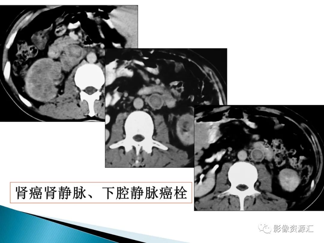 影像PPT - 【PPT】肾癌的CT MRI诊断-29