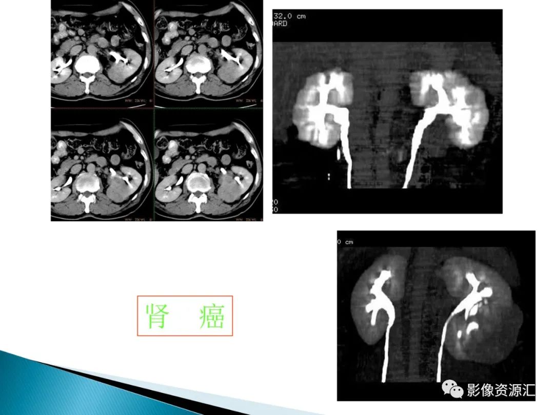 影像PPT - 【PPT】肾癌的CT MRI诊断-30