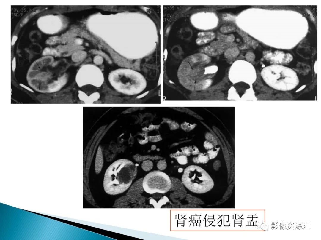 影像PPT - 【PPT】肾癌的CT MRI诊断-31