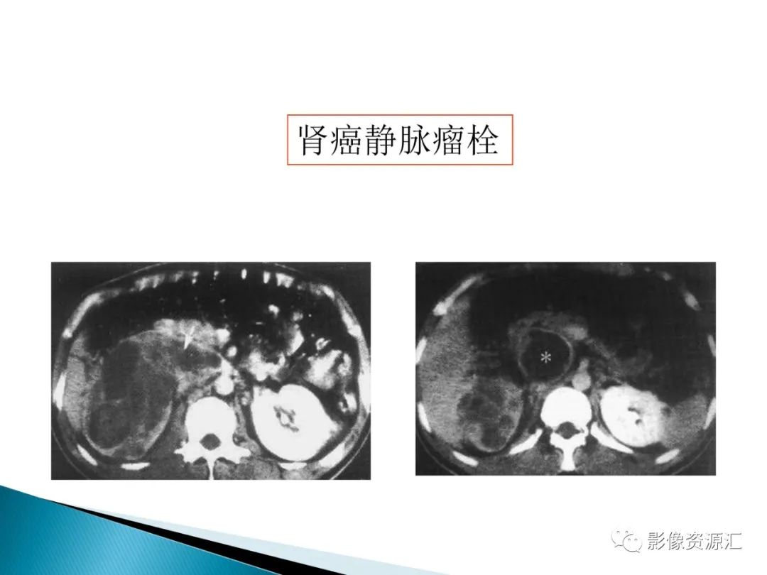 影像PPT - 【PPT】肾癌的CT MRI诊断-32