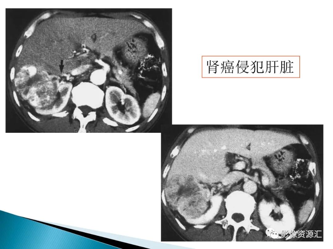 影像PPT - 【PPT】肾癌的CT MRI诊断-33