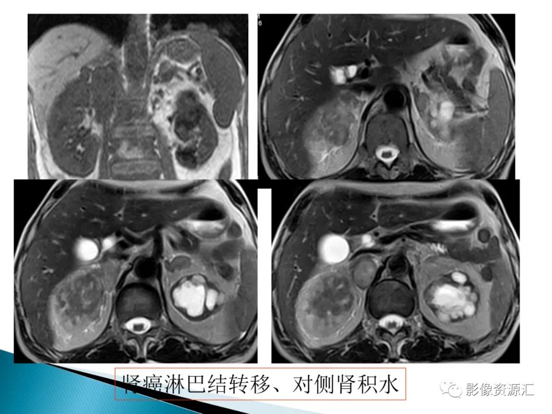 影像PPT - 【PPT】肾癌的CT MRI诊断-36