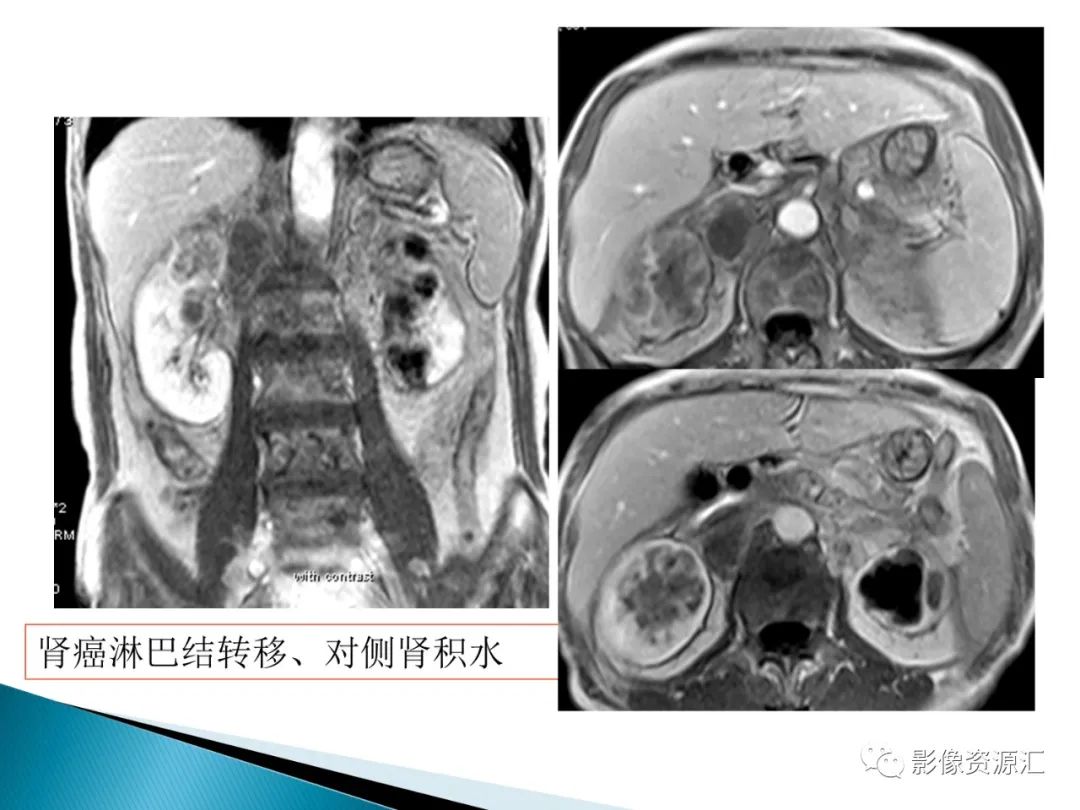 影像PPT - 【PPT】肾癌的CT MRI诊断-37