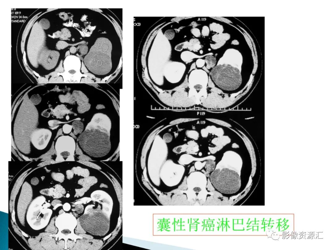 影像PPT - 【PPT】肾癌的CT MRI诊断-38