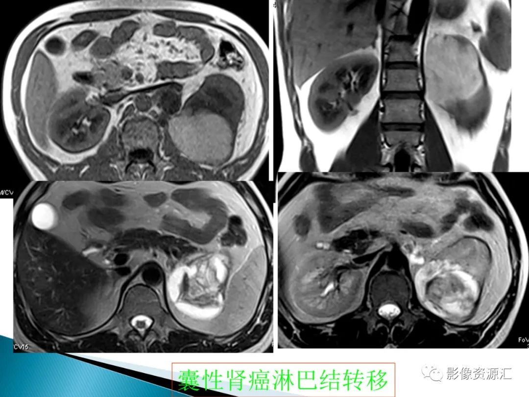 影像PPT - 【PPT】肾癌的CT MRI诊断-39