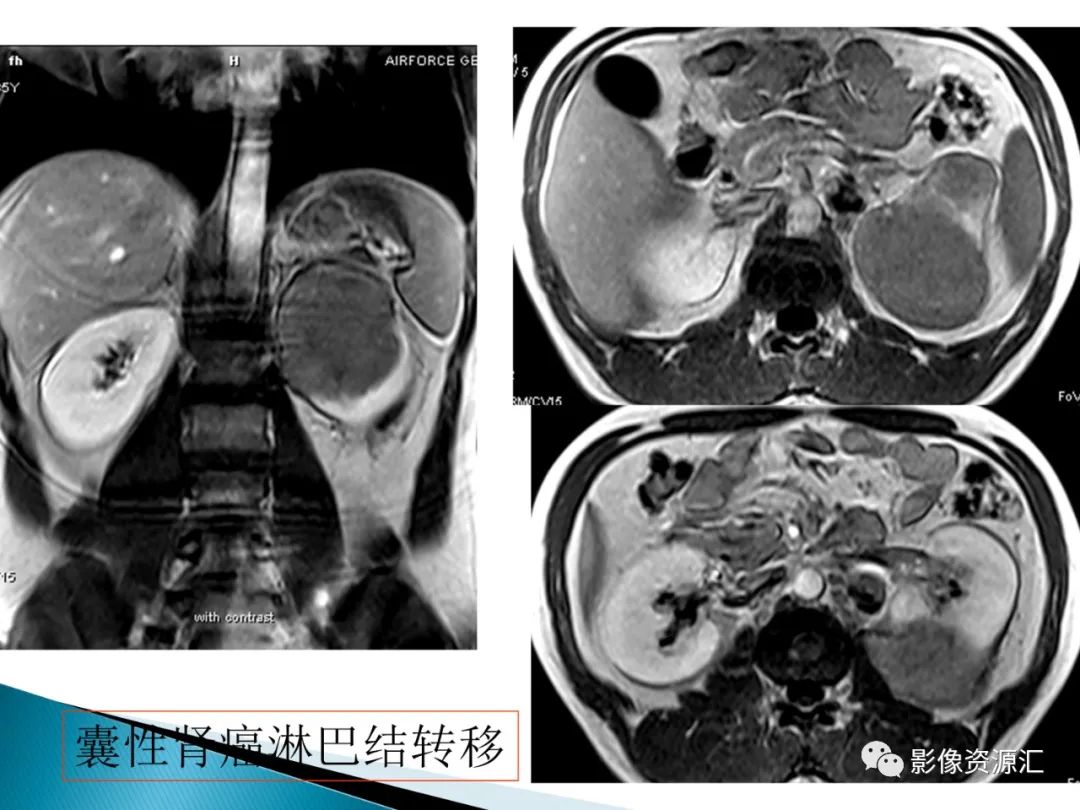 影像PPT - 【PPT】肾癌的CT MRI诊断-40
