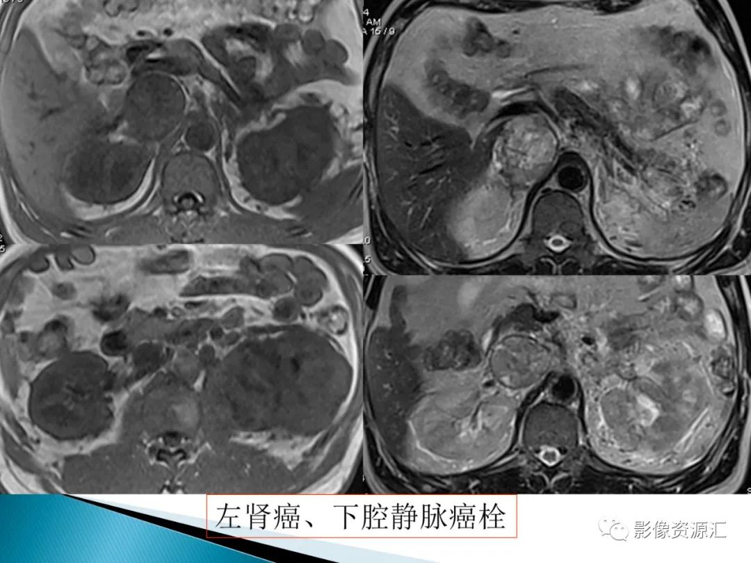 影像PPT - 【PPT】肾癌的CT MRI诊断-41