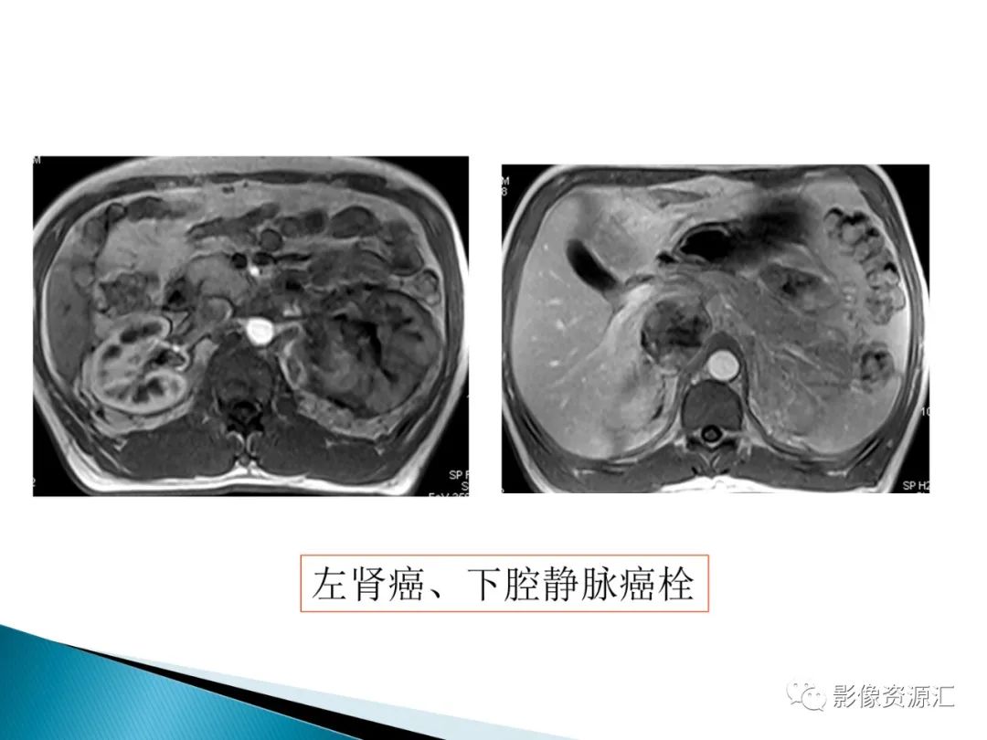 影像PPT - 【PPT】肾癌的CT MRI诊断-42