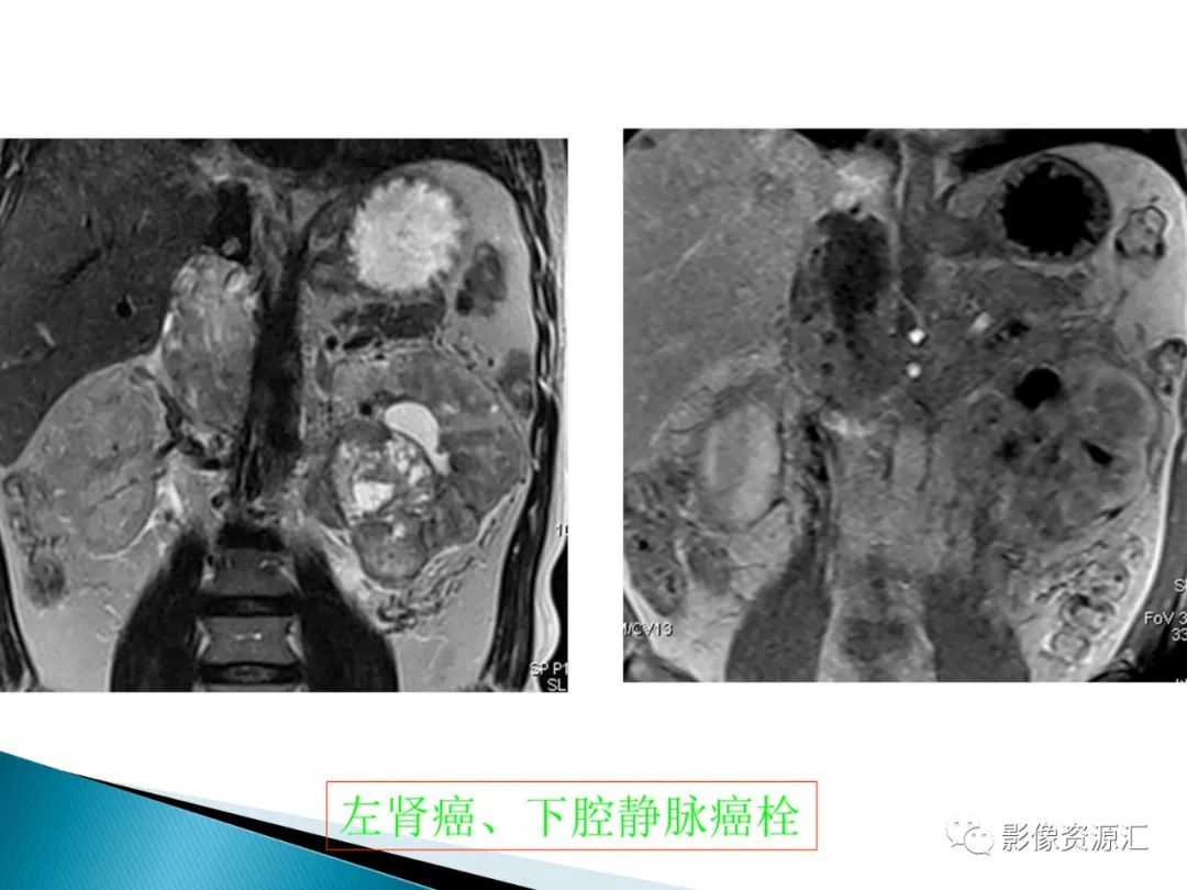 影像PPT - 【PPT】肾癌的CT MRI诊断-43