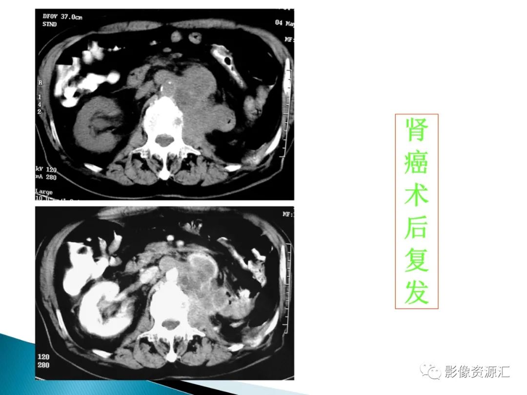 影像PPT - 【PPT】肾癌的CT MRI诊断-45