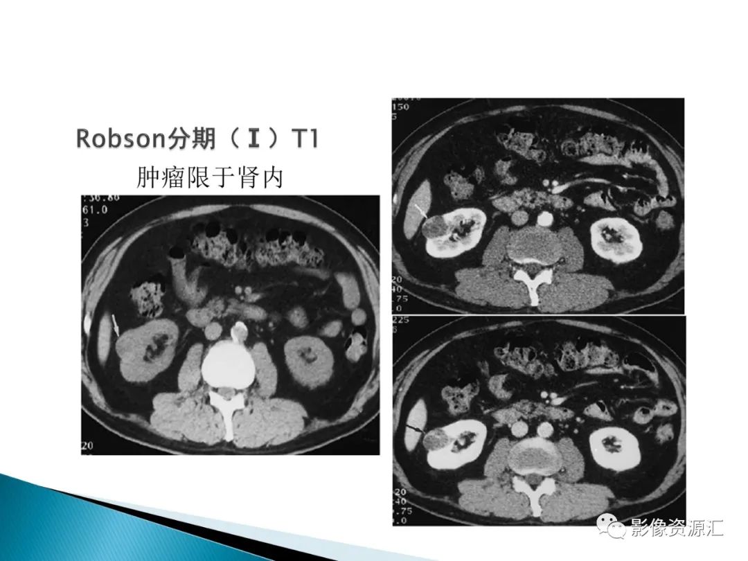 影像PPT - 【PPT】肾癌的CT MRI诊断-49