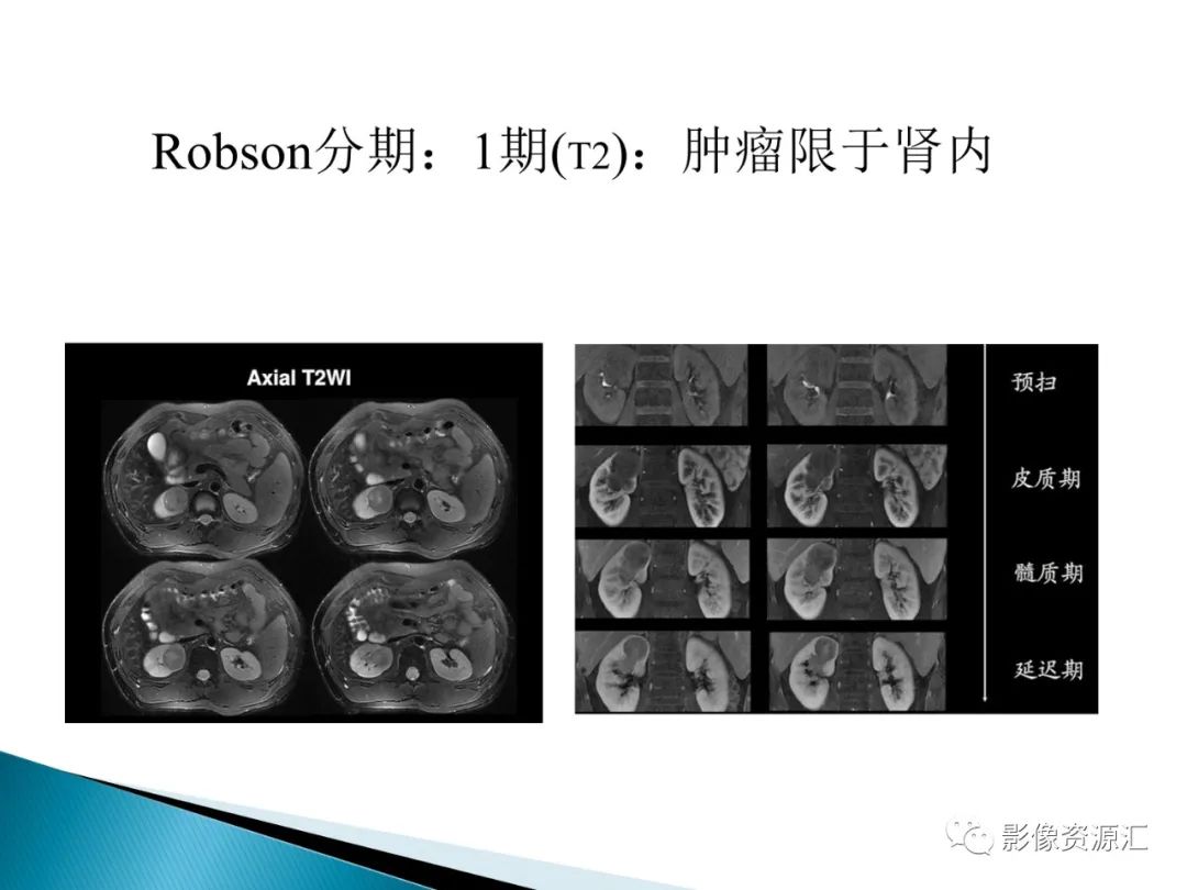 影像PPT - 【PPT】肾癌的CT MRI诊断-50