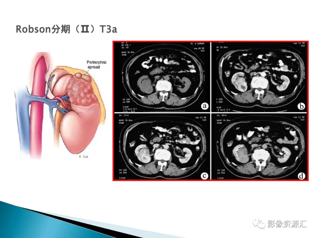 影像PPT - 【PPT】肾癌的CT MRI诊断-51