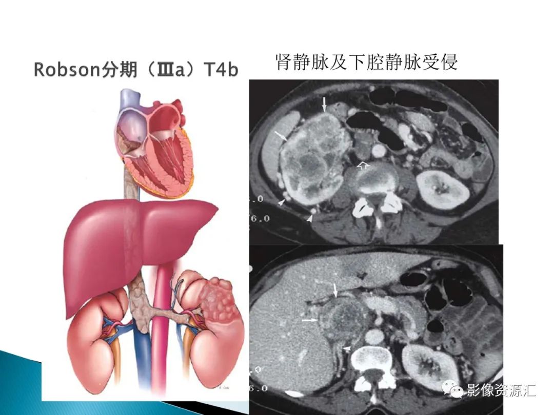 影像PPT - 【PPT】肾癌的CT MRI诊断-52
