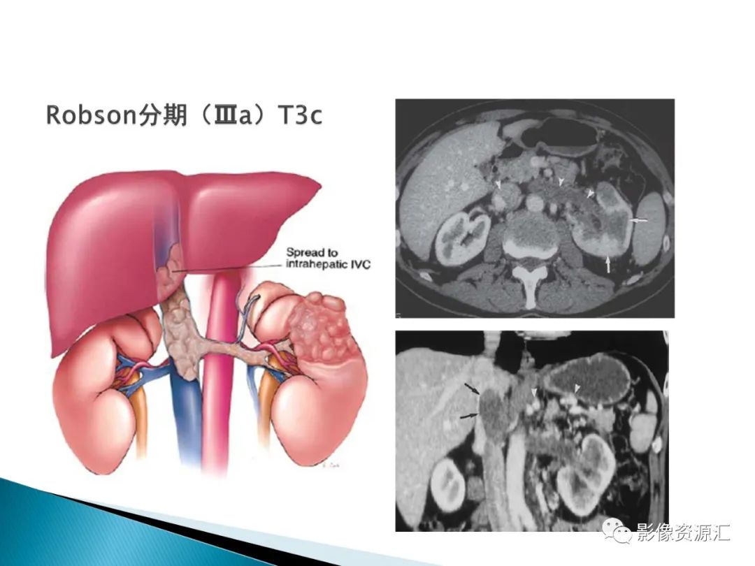影像PPT - 【PPT】肾癌的CT MRI诊断-53