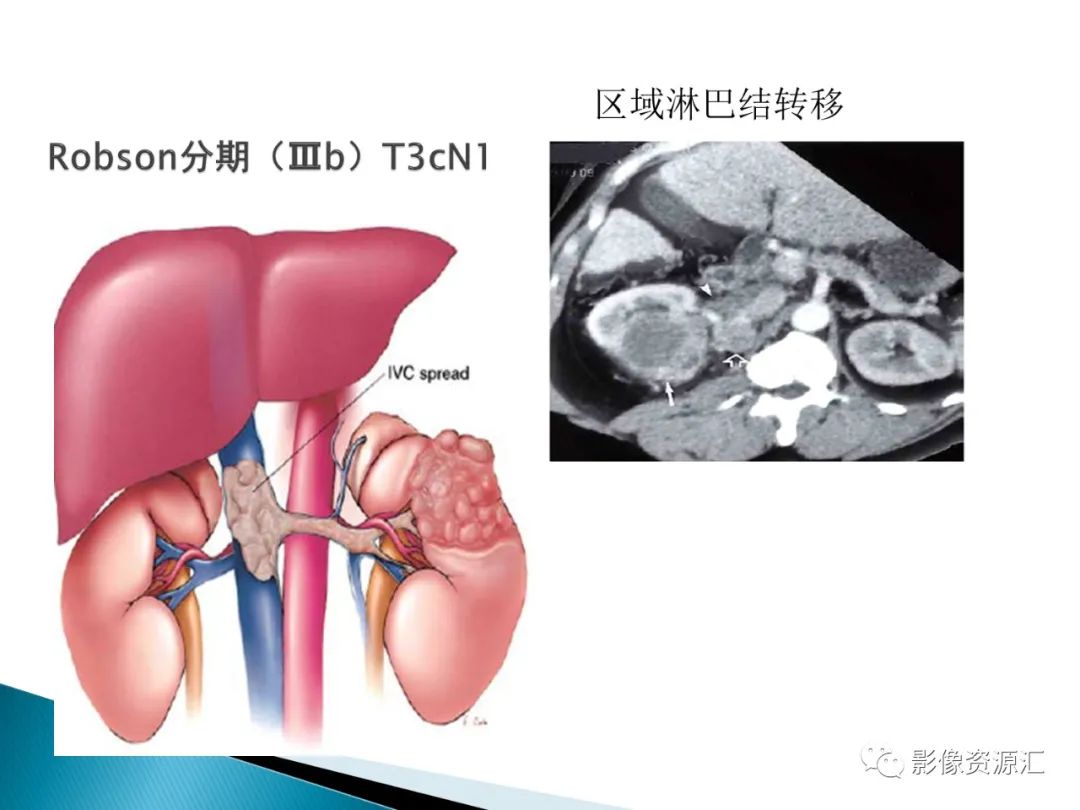 影像PPT - 【PPT】肾癌的CT MRI诊断-54