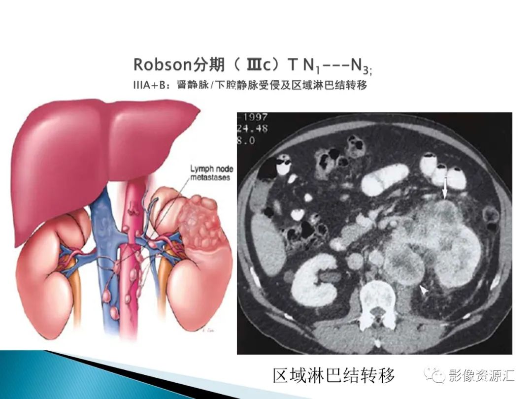 影像PPT - 【PPT】肾癌的CT MRI诊断-55