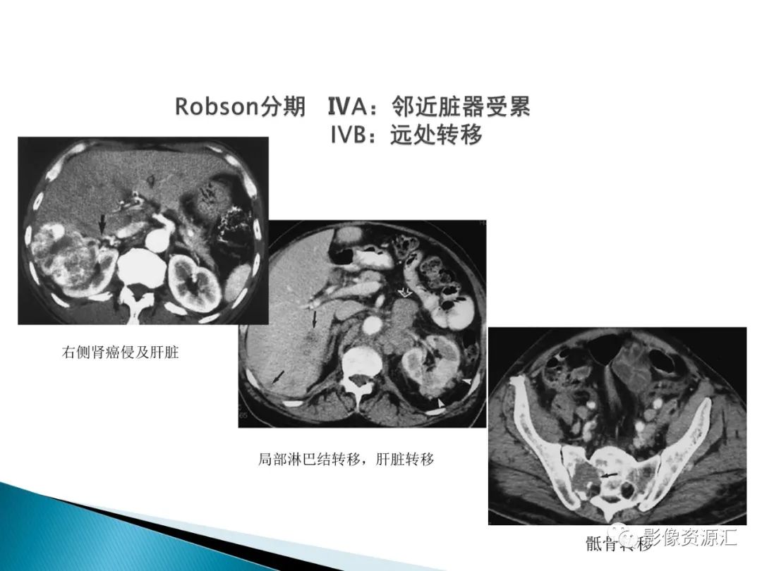 影像PPT - 【PPT】肾癌的CT MRI诊断-56